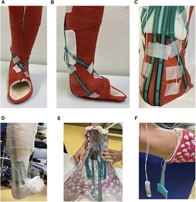 Assessment of compression forces in a digitally modified short leg cast for pressure injury risk monitoring in healthy children